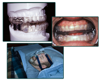 Dental device for sleep apnea Dental device for sleep apnea